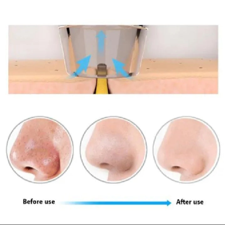 Electric Blackhead Remover – Deep Pore Vacuum Cleaner for Acne, Oil & Dead Skin